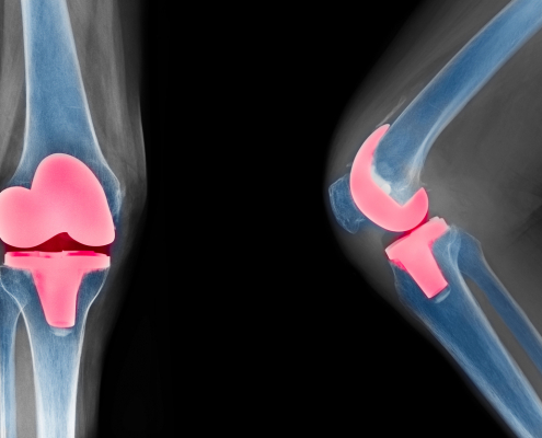knee x-ray show total knee replacement