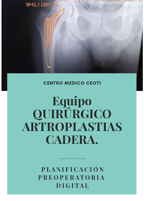 artroplastia de cadera